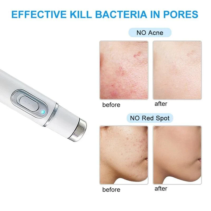 Laser Ultrasonic Skin Tightening Machine - Image 3